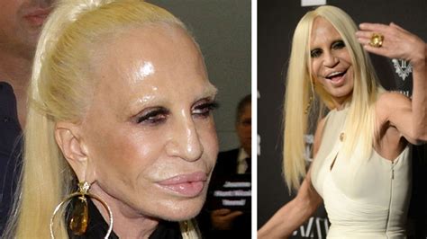 donatella versace operacje plastyczne